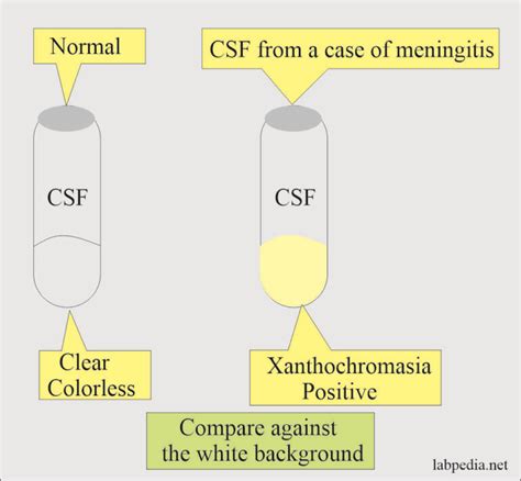 csf drop test|what is a csf test.